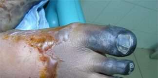 Chủ quan lợn sạch lãnh viêm màng não