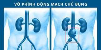 Bệnh viện Gia An 115 cấp cứu thành công cụ ông vỡ phình động mạch chậu chung nguy hiểm