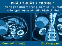Đại phẫu thành công, cứu sống cụ bà 85 tuổi nhiễm trùng nang gan, sỏi túi mật với nhiều bệnh lý nền