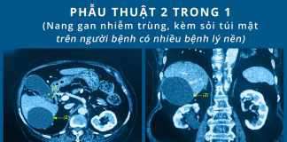 Đại phẫu thành công, cứu sống cụ bà 85 tuổi nhiễm trùng nang gan, sỏi túi mật với nhiều bệnh lý nền