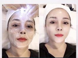 Mesotherapy – Dịch vụ làm đẹp trải nghiệm công nghệ tiên tiến