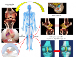Vinmec tái tạo chính xác dây chằng chéo trước khớp gối với phương pháp “ánh xạ giải phẫu” độc quyền