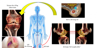 Vinmec tái tạo chính xác dây chằng chéo trước khớp gối với phương pháp “ánh xạ giải phẫu” độc quyền