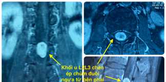 Hoàn Mỹ ITO Đồng Nai – Phẩu thuật u bao sợi thần kinh thành công cho bệnh nhân 59 tuổi