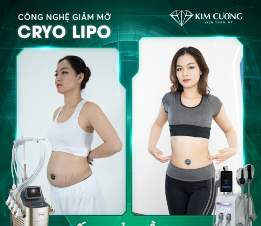 Khám phá siêu công nghệ giảm béo chuẩn y khoa Cryolipo hot nhất hiện nay