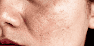 PGS.TS BS Da liễu cao cấp tiết lộ giải pháp cho da thâm nám mà ngành thẩm mỹ luôn muốn che dấu bạn