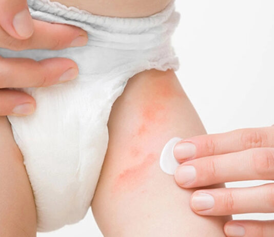 Đa số mẹ bỉm Hà Nội đang chọn bỉm sai cách, khiến con bị hăm vào mùa hè